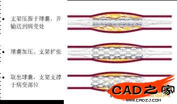 支架植入過程示意圖